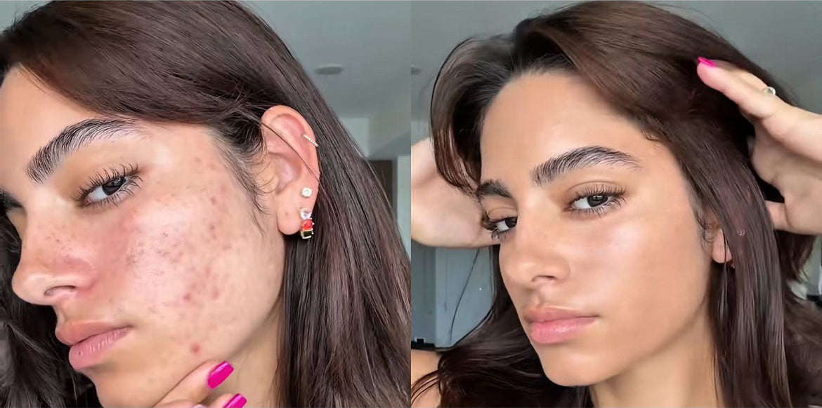 Before and after comparison of a woman's face with acne and clear skin.